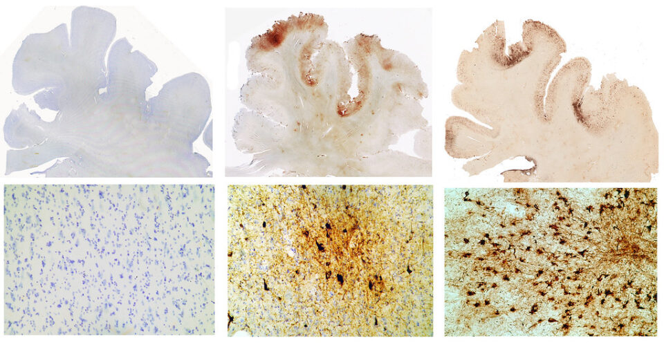 Frontal cortex slides from CTE study. From Left to Right:(1): A normal brain from a 65 year old (2): The brain of a former NFL linebacker, John Grimsley (who suffered 8 concussions and died at age 45) (3): The brain of a 73 year old boxer who suffered from an extreme form of dementia pugilistica 